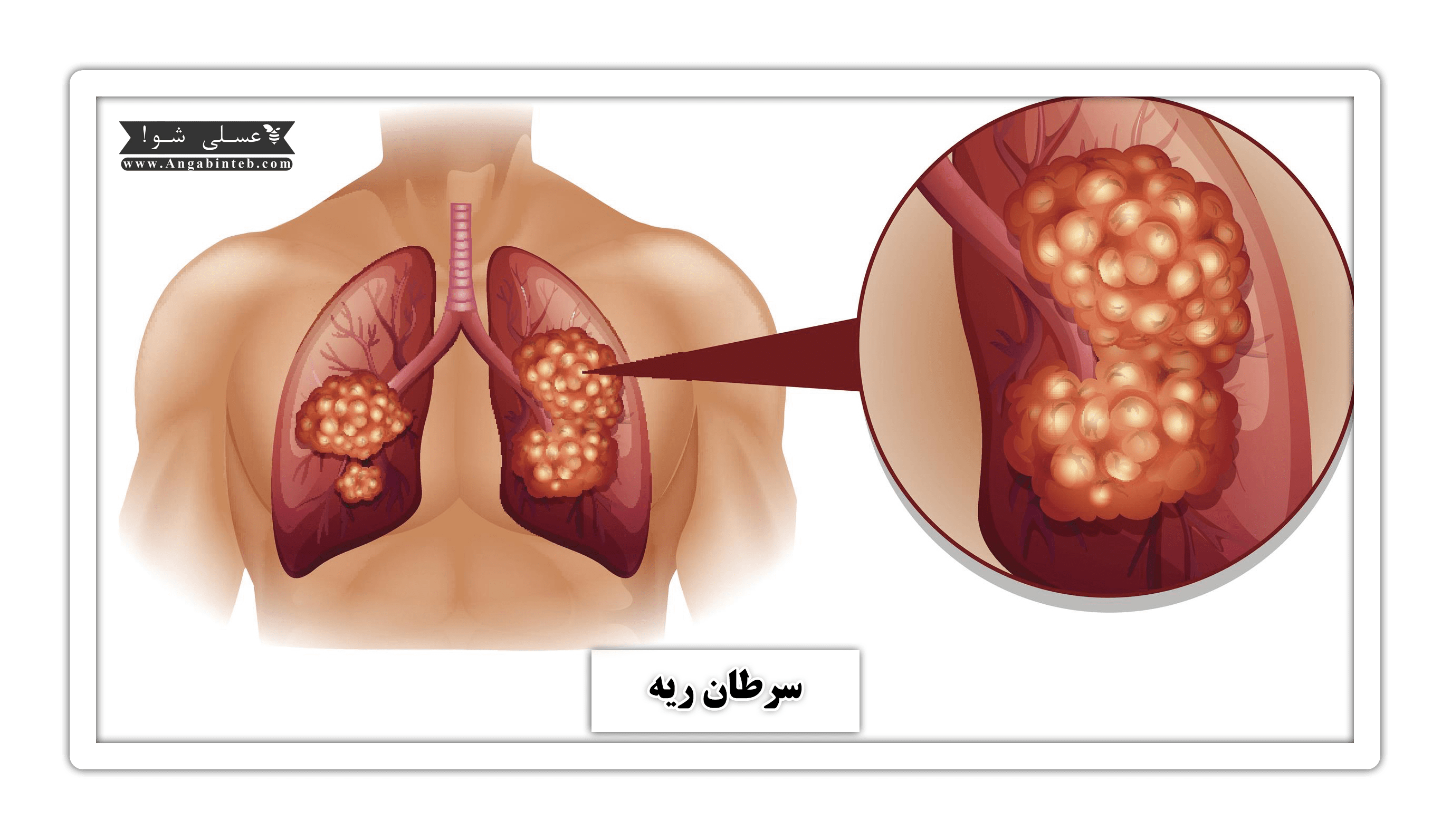 lung cancer-title